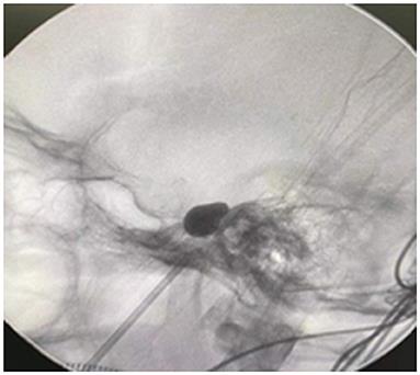 Treatment of Third Branch Trigeminal Neuralgia With a Balloon Inflated in the Foramen Ovale